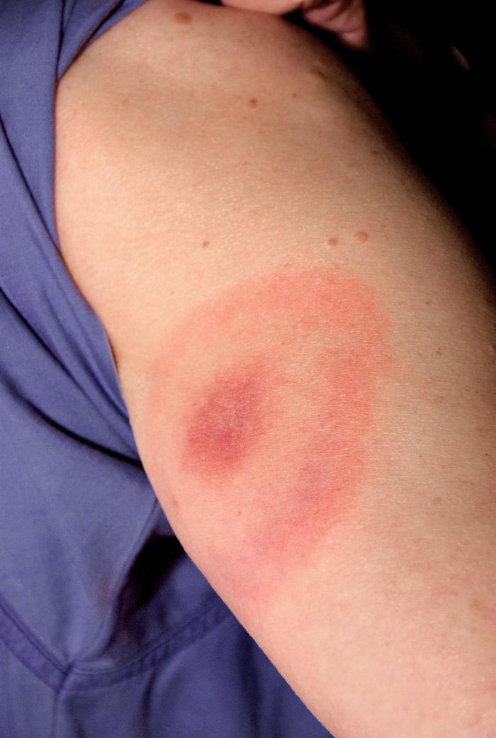 Photo of Lyme disease rash